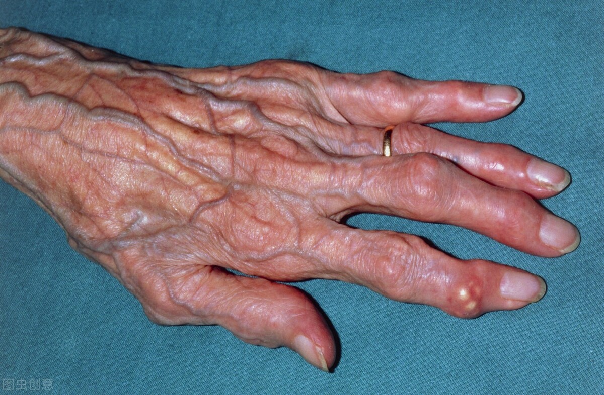 痛风发作和不发作的危害,痛风不仅仅是关节炎