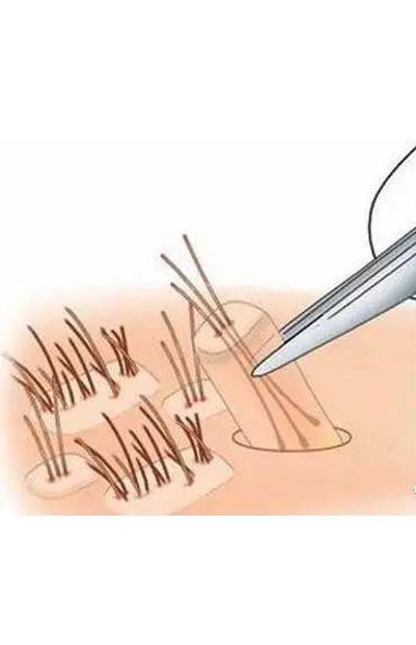 头发种植手术是如何种植的,头发种植利弊有哪些呢