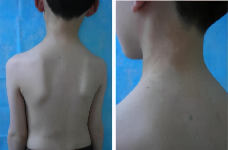 白斑是白癜风还是糠疹如何鉴别呢,宝宝脸上有白斑是脾胃虚吗