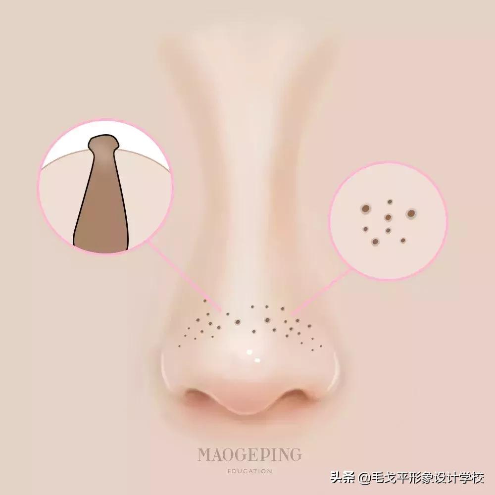 有黑头又泛红的草莓鼻怎么办,毛孔粗大草莓鼻清理黑头