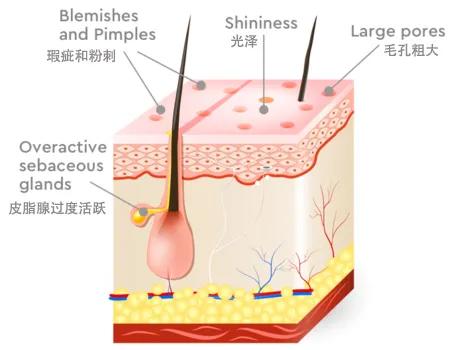 皮肤干却容易出油是干皮还是油皮,皮肤有油皮怎么办小妙招