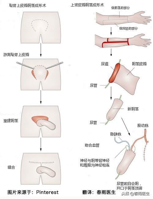 女变男手术风险大吗,女变男手术事例