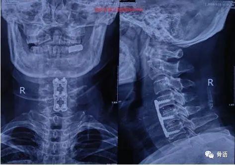 交感神经型颈椎病康复训练,神经根型颈椎病术后康复锻炼视频