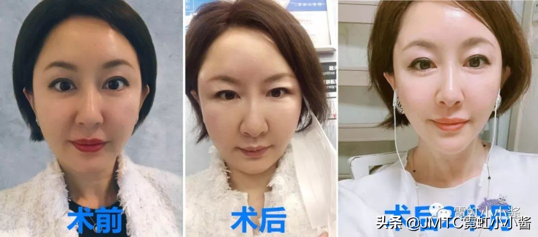 日本小姐姐针灸瘦脸视频,小姐姐打瘦脸针视频