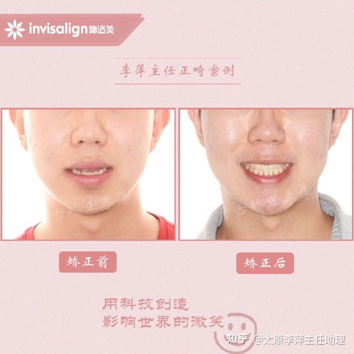 太原矫正牙齿需要做正颌吗,太原牙齿二次矫正