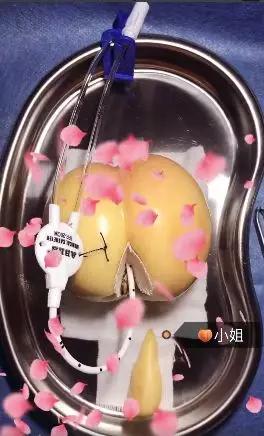 我在快手上看人切洋葱，竟然弄懂了剖腹产？