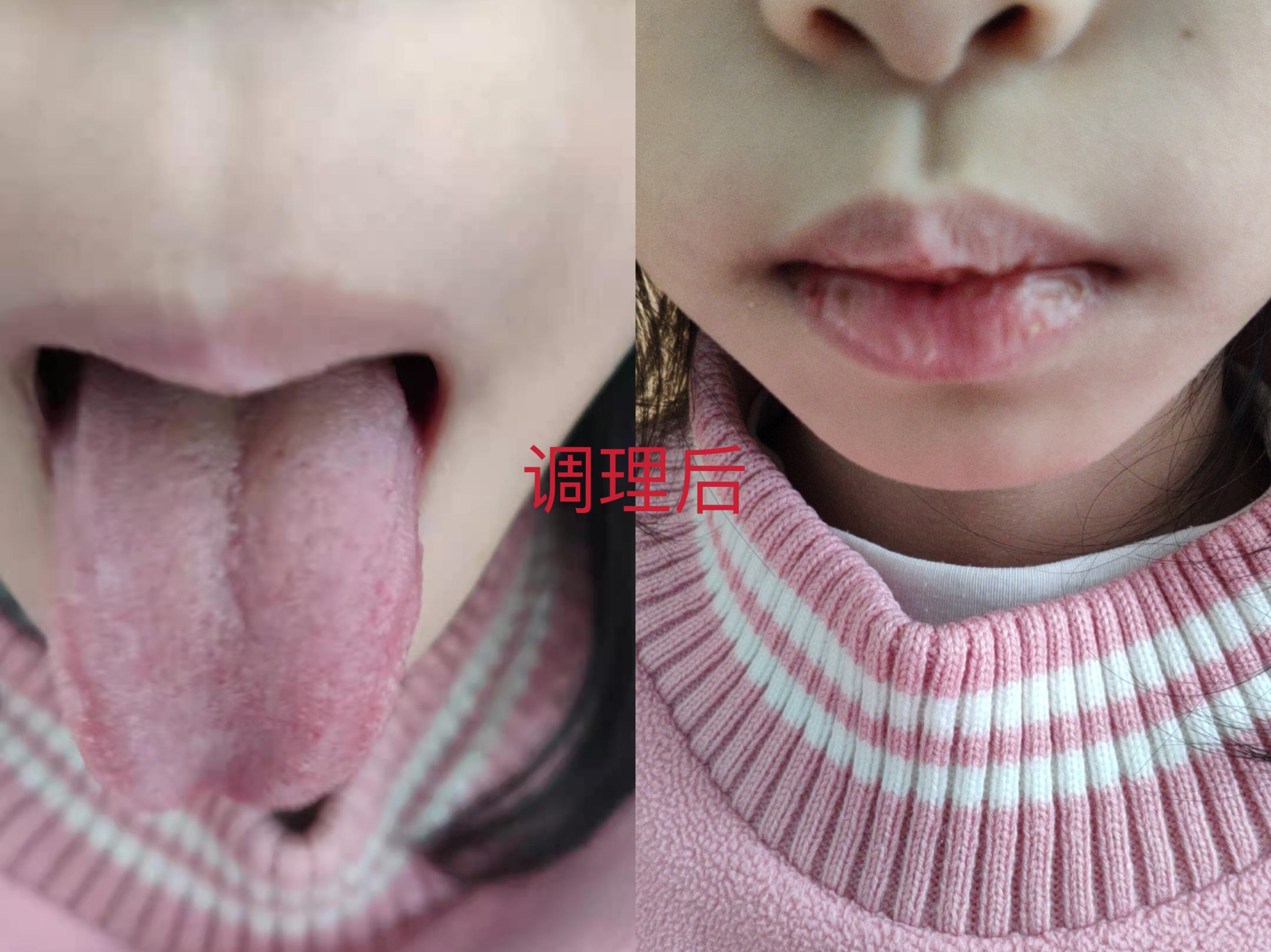 陈久积食发烧中医处理方法,中医积食内热咳嗽推拿手法