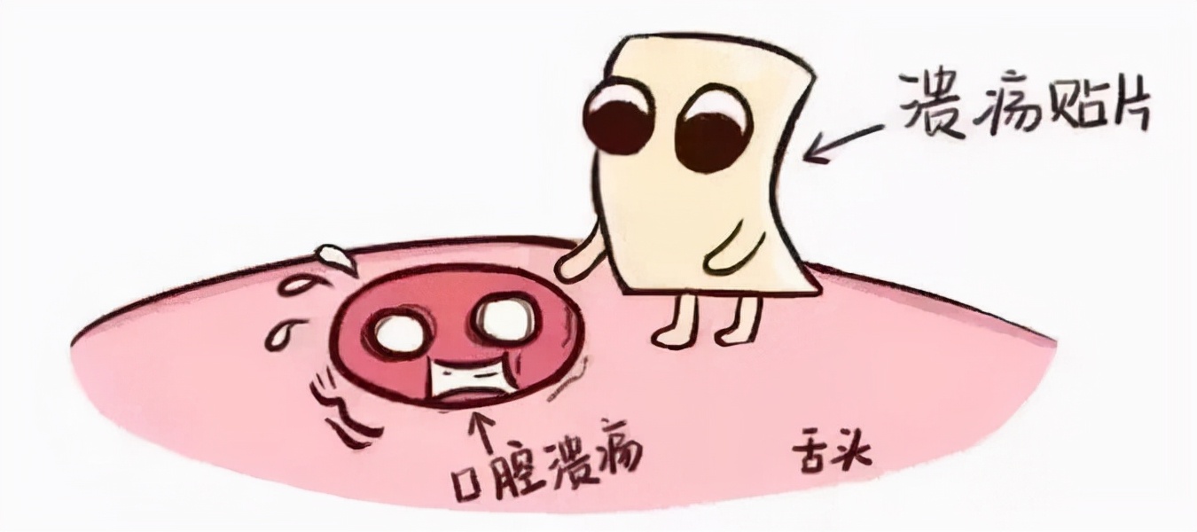 外国人如何应对口腔溃疡,总是口腔溃疡试试这7个防治方法