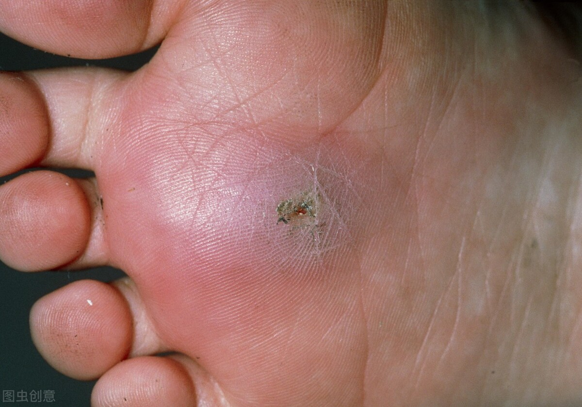 重症破伤风治疗指南2018,重症破伤风治愈经历