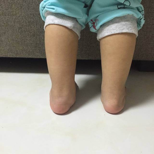 膝外翻的判定方法,足外翻导致膝外翻的最佳锻炼方法