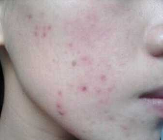 青春“悔恨”痘印该如何解决？详细解决方法全解答，不再“作死”