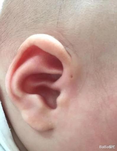 为什么有些新生儿耳朵大有些小,为什么新生儿耳朵旁边有小肉疙瘩
