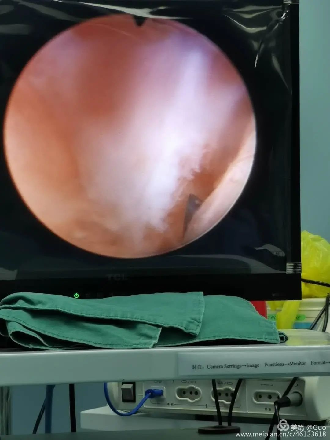 摘除节育环手术,节育环的摘除手术