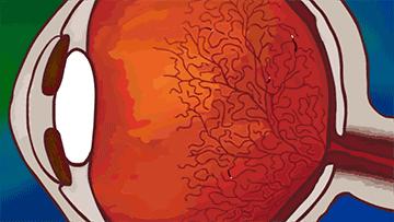 眼前一直有蚊子是什么病,眼前总有蚊子飞怎么治呀