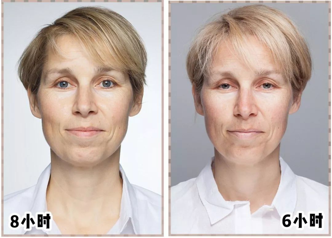 警惕你的脱发可能与它有关,脱发后变老变丑