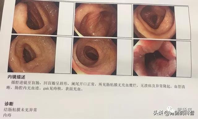 给大家科普胃肠镜,胃肠镜科普讲座