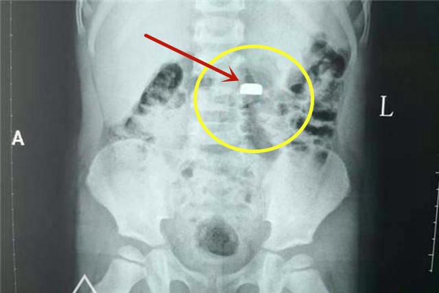 宝宝误吞纽扣电池多久有反应,宝宝误吞了纽扣电池怎么办