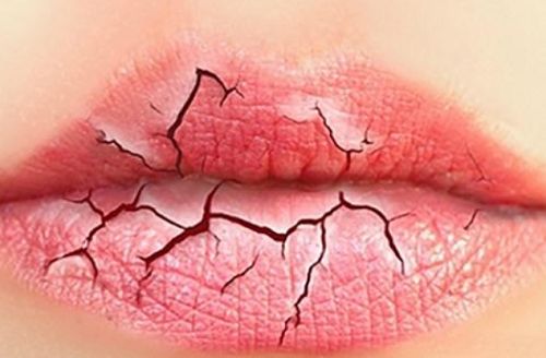 舔舔舔!唇炎找上门来怎么办?!