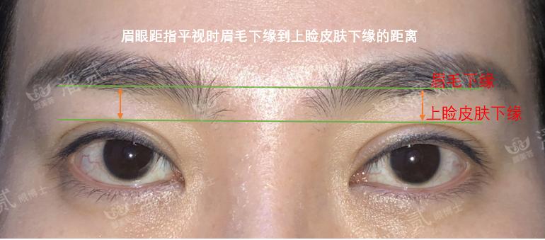 双眼皮离眉毛太近还能修复好吗,割双眼皮眉毛下面肿会消肿吗