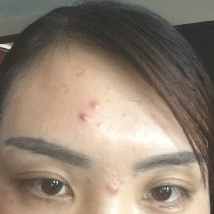 脸上的痘痘印子怎么去除小技巧,怎样去除脸上的痘痘最快最有效