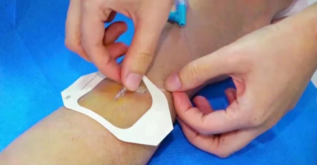 留置针软管断裂有什么症状,留置针的软管断在里面怎么办