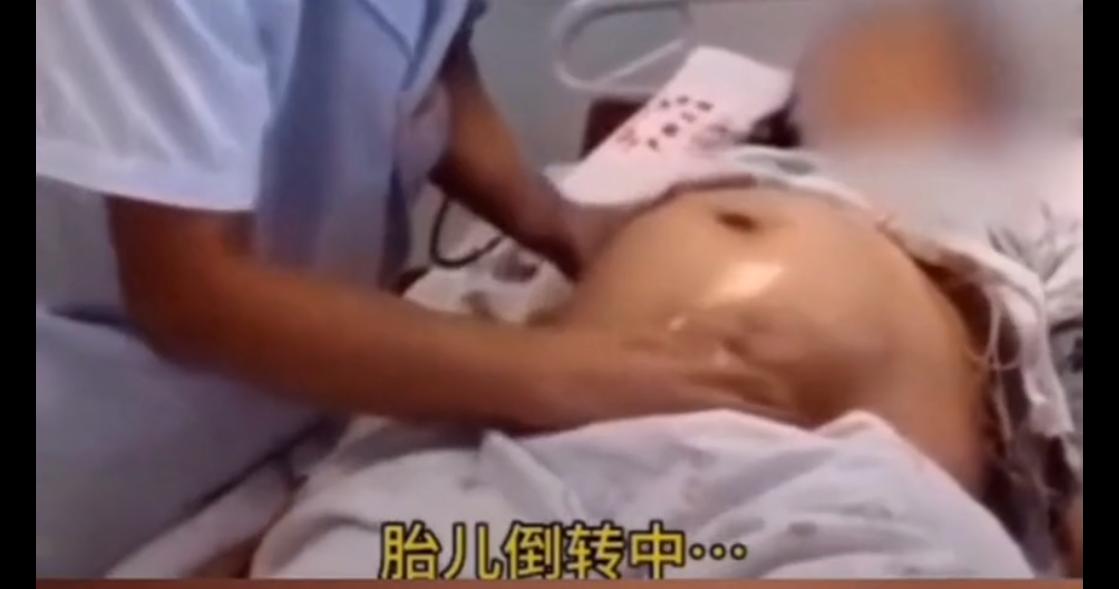孩子臀位无法顺产，医生徒手将孩子转正，会这个技术的不多了