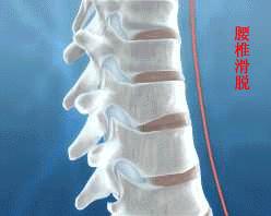 腰椎滑脱坐姿和站姿要注意吗,腰椎滑脱手术拆线后注意事项