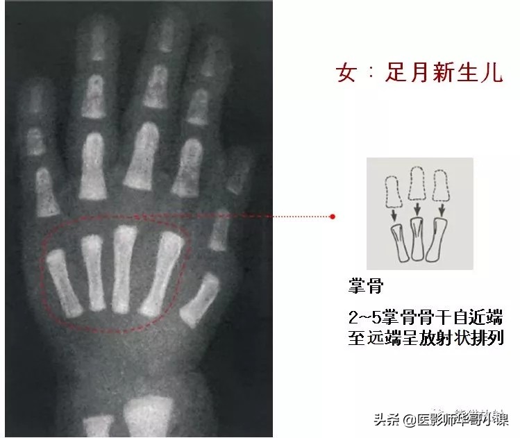 骨龄片对照图谱测骨龄准不,骨龄14岁男孩骨龄图谱