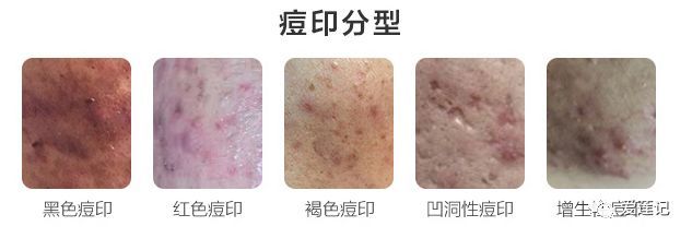 别瞎治了！痘痘的治疗原则是这4点