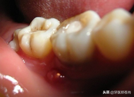 智齿肿痛会使手关节肿痛吗,智齿牙龈肿痛智齿不疼