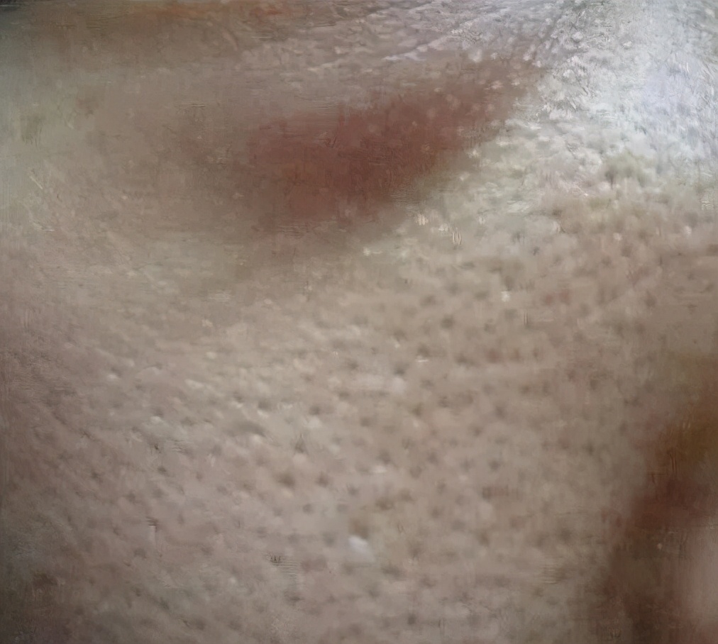 皮肤蜡黄粗糙毛孔粗大喝什么调理,皮肤科黑头粉刺毛孔粗大怎么调理