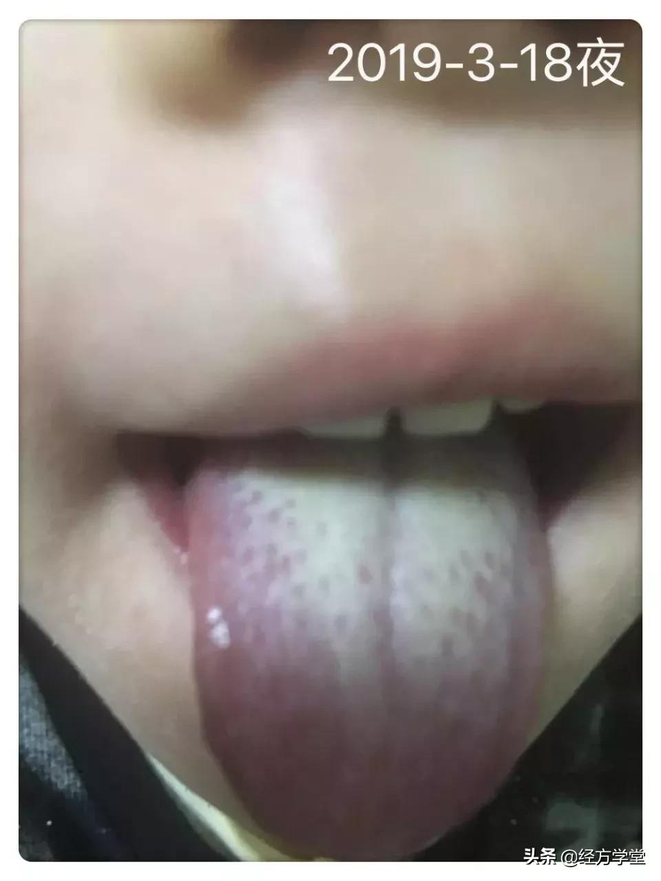 小柴胡汤加升降散医案,小柴胡颗粒治感冒后期咳嗽