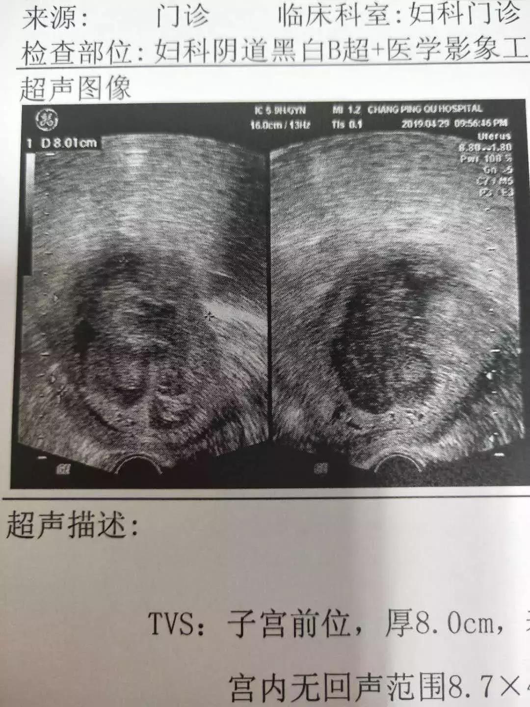 什么是葡萄胎做b超看出来吗,什么是葡萄胎形成原因是什么