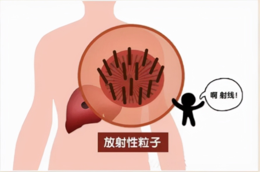 肿瘤介入微创疗法要多少钱,微创治疗肿瘤有哪些手段