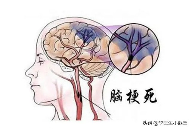 老年人预防脑梗可以长期吃叶酸吗,预防脑梗怎么补充叶酸和维生素b12