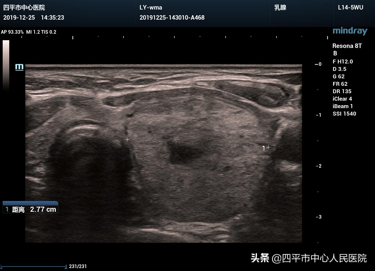 超声引导下甲状腺结节微波消融术,甲状腺结节微波消融术哪有做的