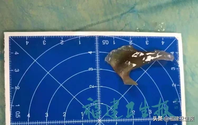 小伙误吞鱼骨视频,误吞鱼刺的真实案例