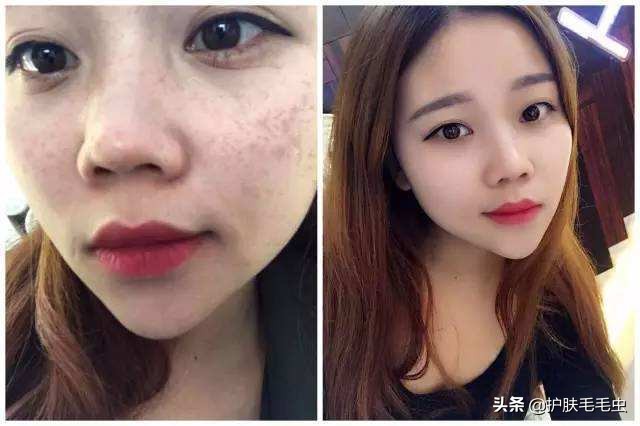 脸颊两侧长斑了怎么快速去除,脸颊两侧长斑的原因和治疗方法