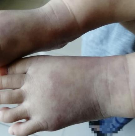 二宝妈妈教你护肤,过敏宝宝的育儿分享