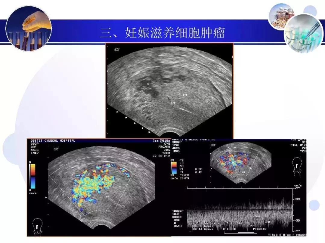 纯干货！子宫及附件解剖和超声诊断