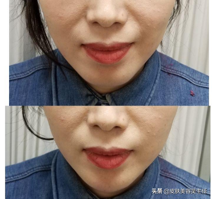 为什么打了玻尿酸脸反而变小了,为什么打玻尿酸脸越来越大