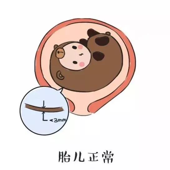 nt值多少才算正常啊,nt不要超过多少值是正常