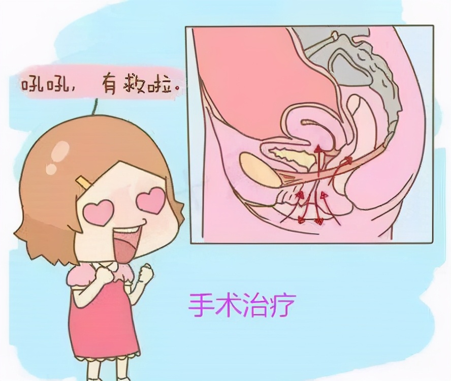 “社交癌”——咳嗽就漏尿，怎么办？