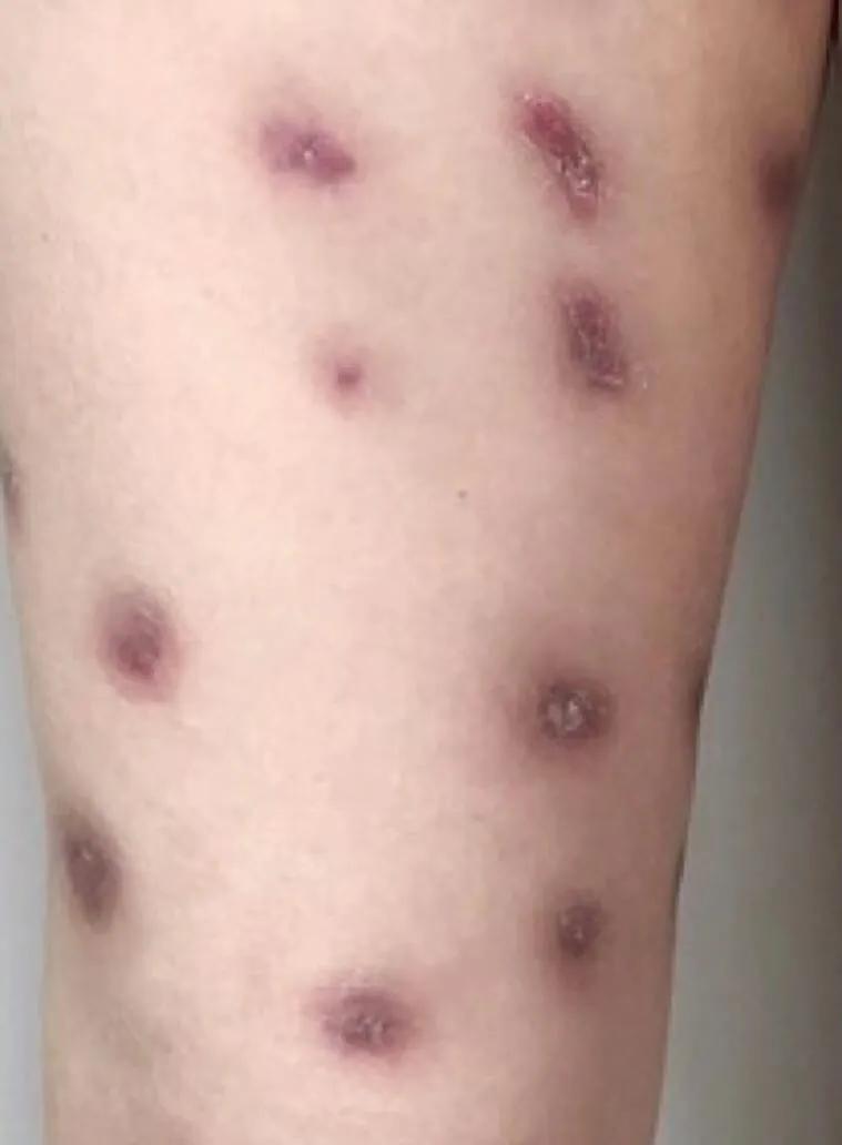 女子在美容院打溶脂针后续,女子打减肥针3天后皮肤溃烂