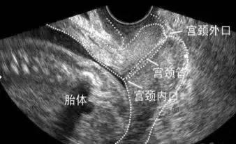 要怎么判断自己是不是早产,先兆早产怎么确定