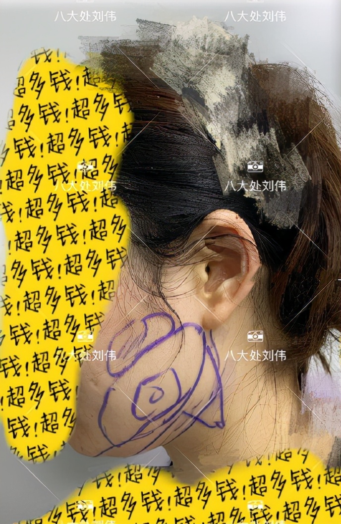 做完面部吸脂有效果吗?为什么我做了看不出来