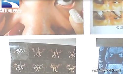 整容失败眼睛失明的案例,玻尿酸隆鼻手术失明