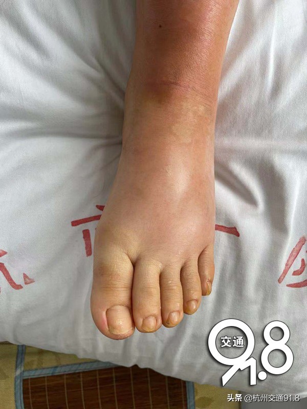 因为脚气！杭州女白领送医救治十几天