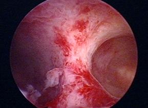 子宫内什么管短容易流产,子宫特别小还有必要治疗吗