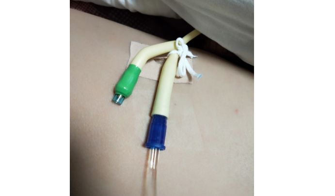 尿管固定别小看5cm，却是“血”的差距